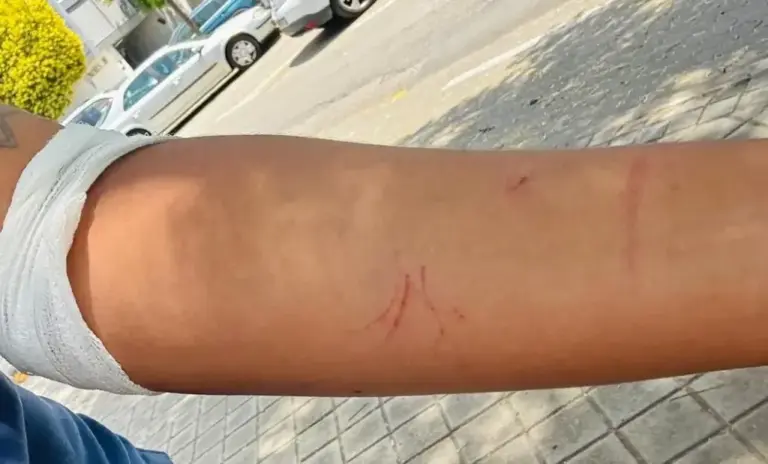 Mel's arm after another day she suffered her ex's rage.