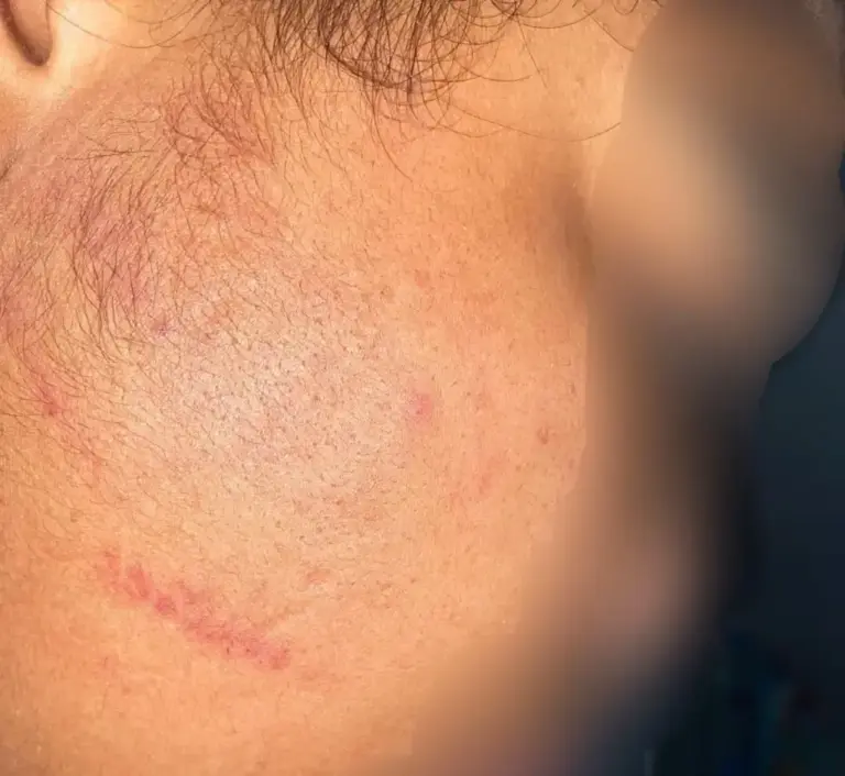 Mel's face after an episode of assaults.