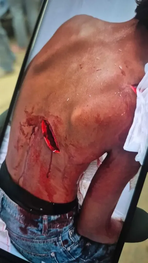An immigrant with several stab wounds on his back after a fight.